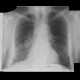 Lung tumour, hilar lymphadenopathy, second radiograph: X-ray - Plain radiograph